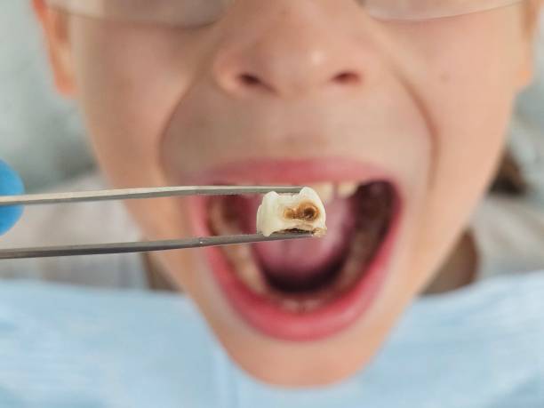 Best Emergency Tooth Extraction in Cameron, TX
